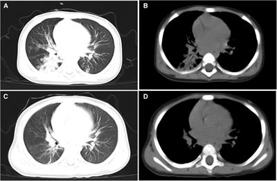 Combined intravenous ribavirin and recombinant human interferon α1b aerosol inhalation for adenovirus pneumonia with plastic bronchitis in children: a case report and review of literature